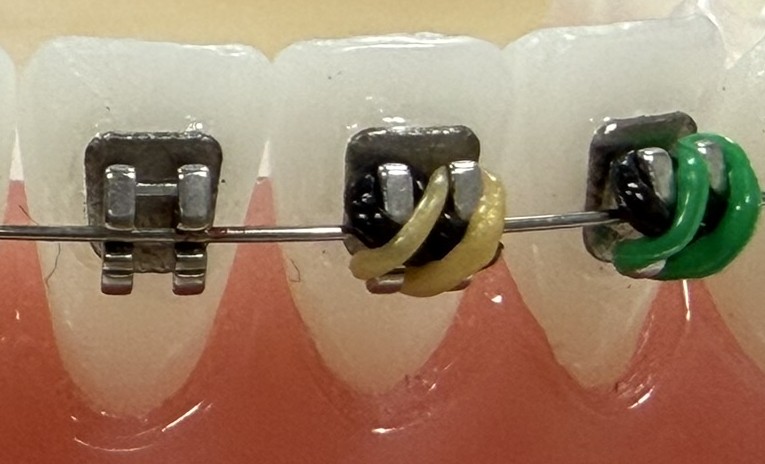 Metallic and polymeric orthodontic brackets